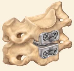 prestige cervical disc surgery
