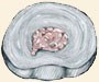 Herniated Discs