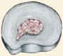 Herniated Discs