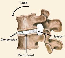 Degenerative Disc Disease (DDD)