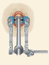 prestige cervical disc surgery