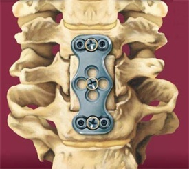 Cervical Corpectomy