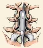 Lumbar Laminectomy