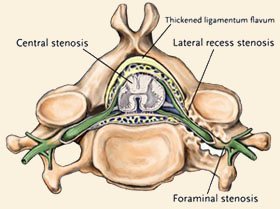 Lumbar Laminectomy