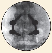 Transforaminal Lumbar Interbody Fusion (PLIF)