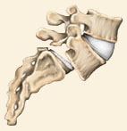 Spondylolisthesis