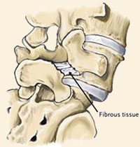 Spondylolisthesis