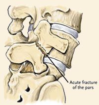 Spondylolisthesis