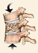 Vertebral Compression Fractures